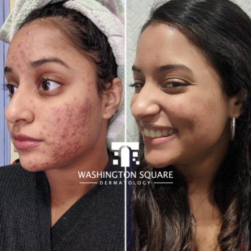 Acne Treatments in NYC - Washington Square Dermatology